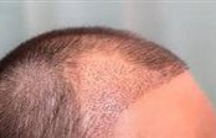 زراعة الشعر بدون ألم .. 6 آثار جانبية محتملة